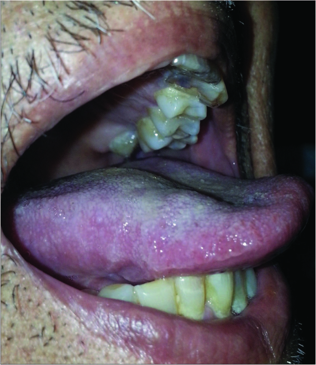 Idiopathic Leukoplakia