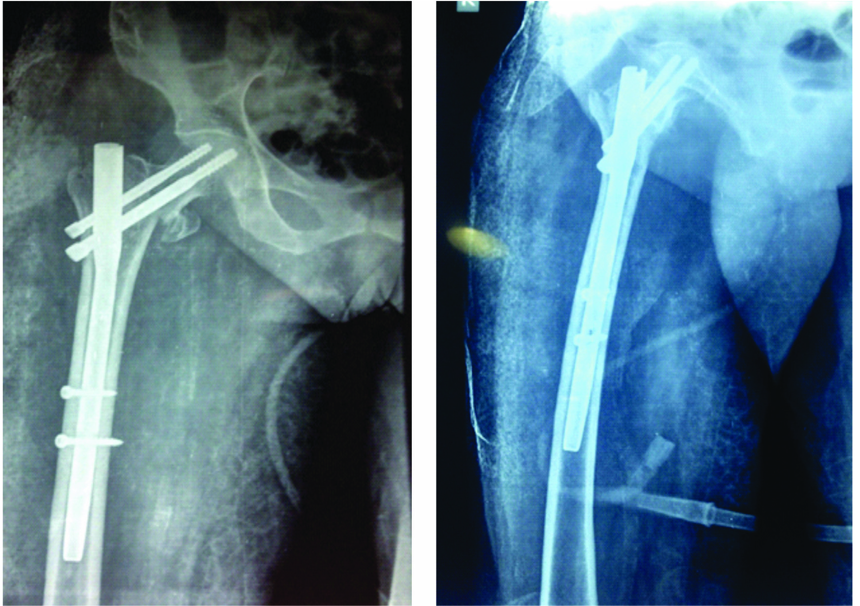 Case 4 Postoperative X Ray Day 90 AP View And Lateral View