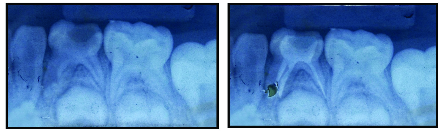 A Preoperative Iopa Radiograph B Postoperative Iopa Radiograph With Over Obturated Canal