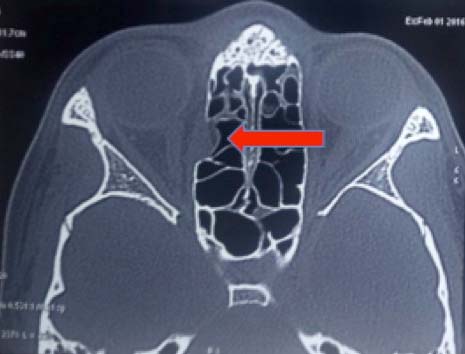 Medial Wall Fracture