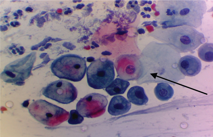 Bacterial Vaginosis Cytology