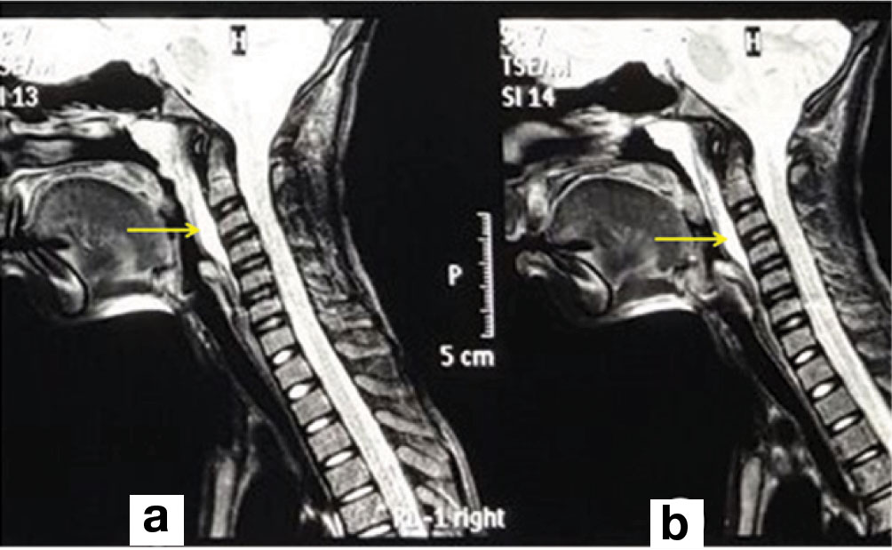 Retropharyngeal Abscess Mri