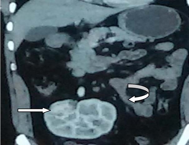 cect-abdomen-showing-fused-kidney-with-bilateral-renal-fossa-empty