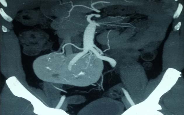 cect-renal-angiography-showing-renal-vessels-coronal-images