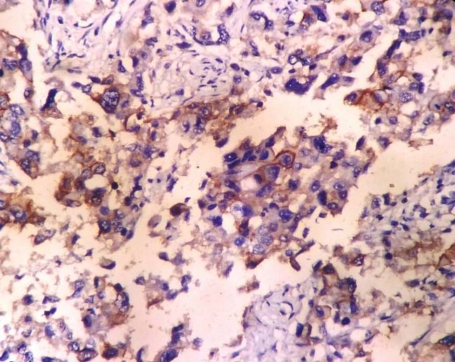 Showing +3 HER-2/neu expression score in a case of cervical ...