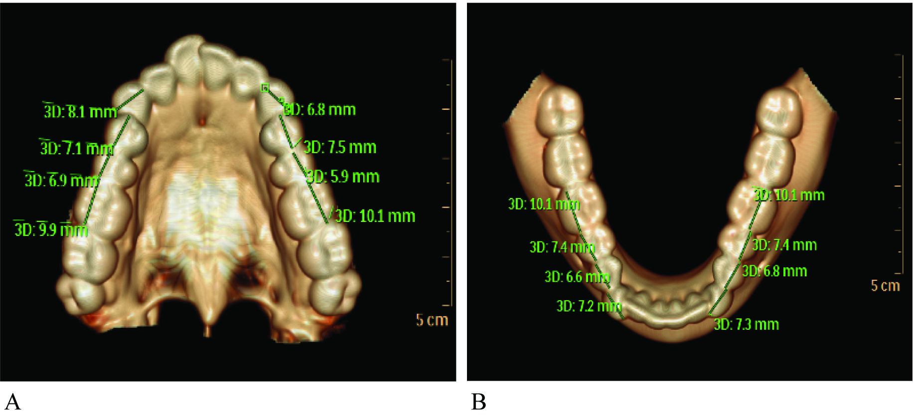 Arch Perimeter : A) Maxillary Jaw; B) Mandibular Jaw.