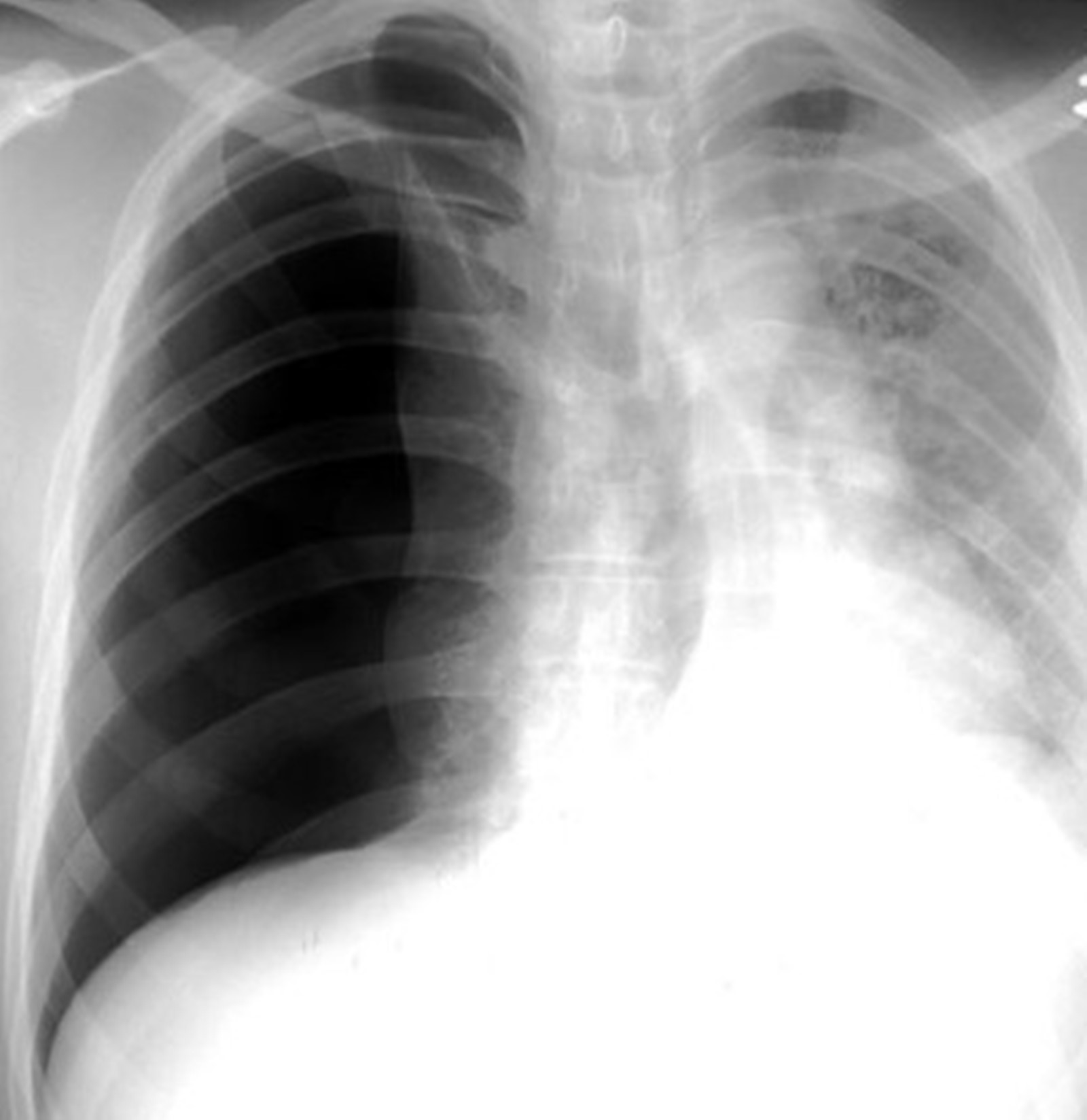 Pneumothorax Chest X Ray