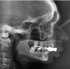 Chin implant placed. (Images from left to right)