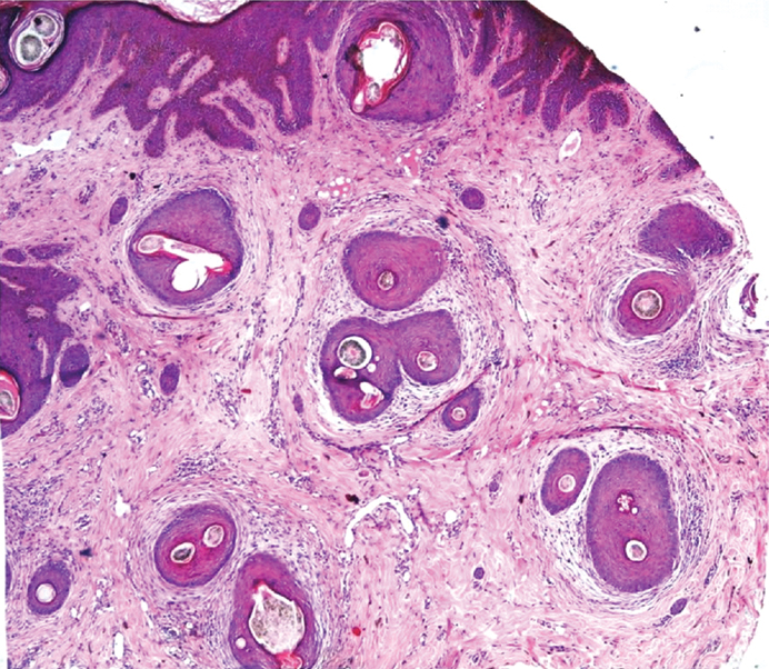 Scarring Alopecia Histology