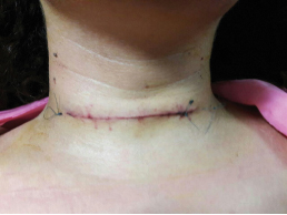 Drainage After Thyroidectomy - Best Drain Photos Primagem.Org