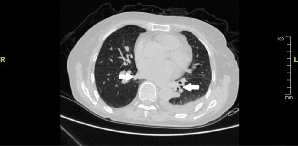 Clinical follow up at three and six months after discharge revealed no ...