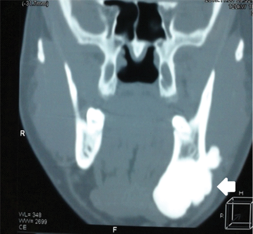 Osteoid Osteoma Jaw