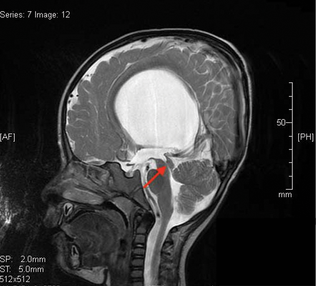 Cerebral Aqueduct Mri