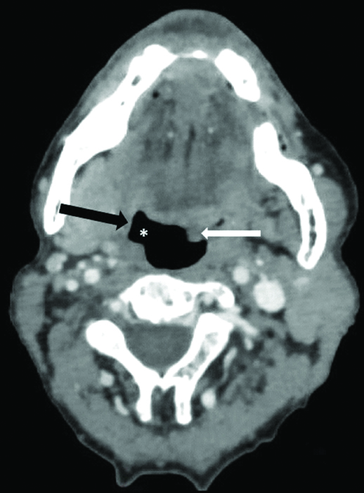 Uvula Infection Mri