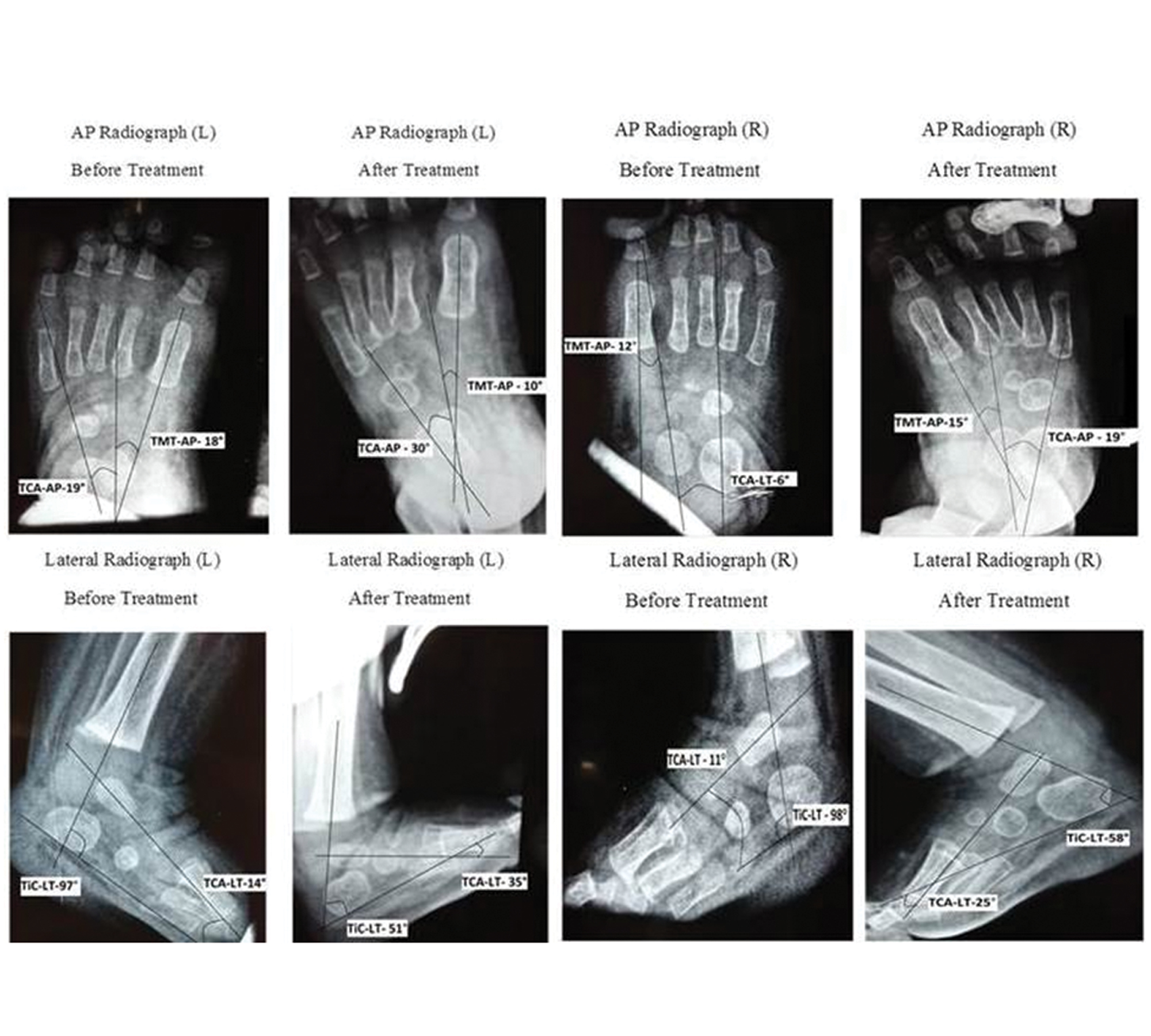 Club Foot Deformity Xray