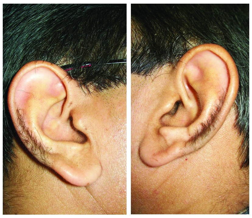 Ear Pinna Hypertrichosis at Cecil Hile blog