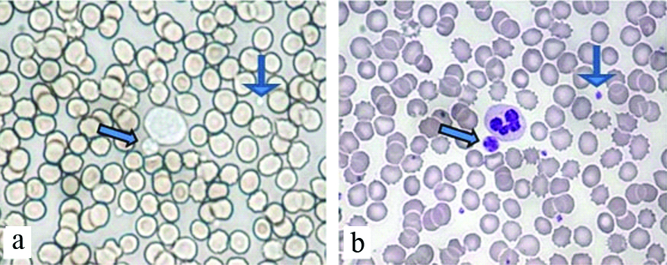 Total Platelet Count Using Hemocytometer Hematology, 56% OFF