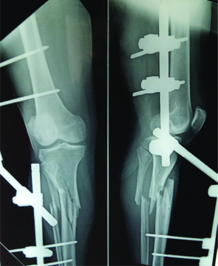 Patient treated with a provisional external fixation.