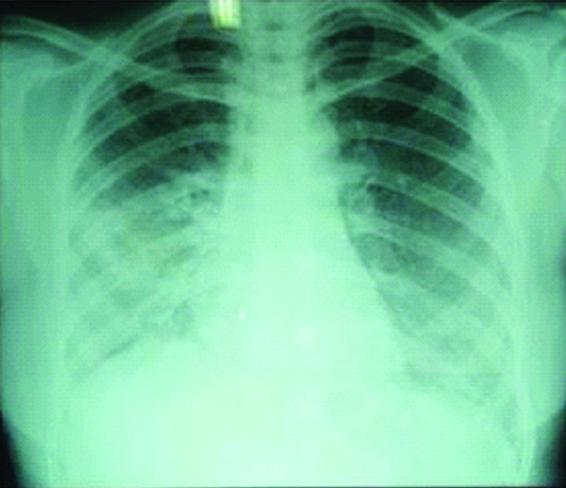 chest-radiograph-showing-non-homogeneous-opacity-in-right-lower-zone