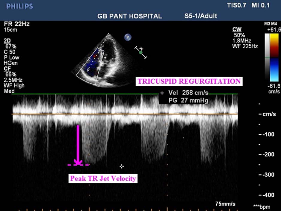 Echocardiogram of one of the patients showing peak TR jet velocity and ...