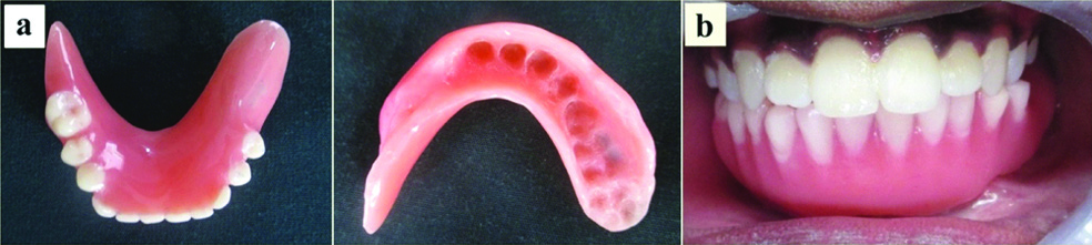 A) Overlay Denture, Occlusal Surface And Intaglio Surface Simulating ...