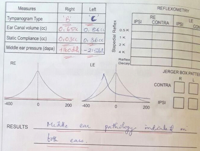 Tympanometry.