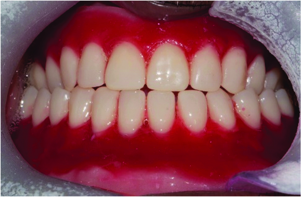 gold-false-teeth-dentures-alternative-treatments-to-dentures-false