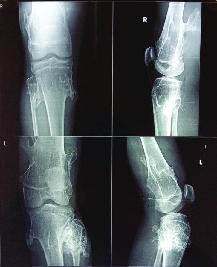 Clinical classification system for HME [ 4 ].