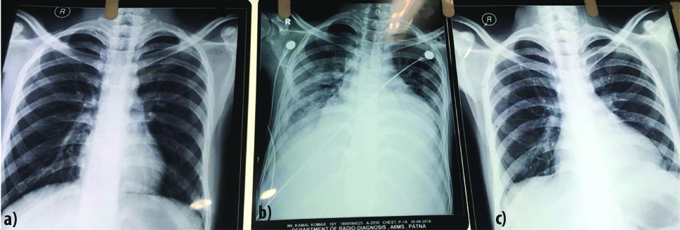 X-ray chest PA view: a) At admission; b) After 10 days when patient ...