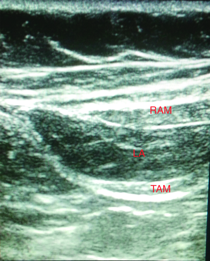 RAM: Rectus abdominis muscle; TAM: Transversus abdominis muscle; LA ...