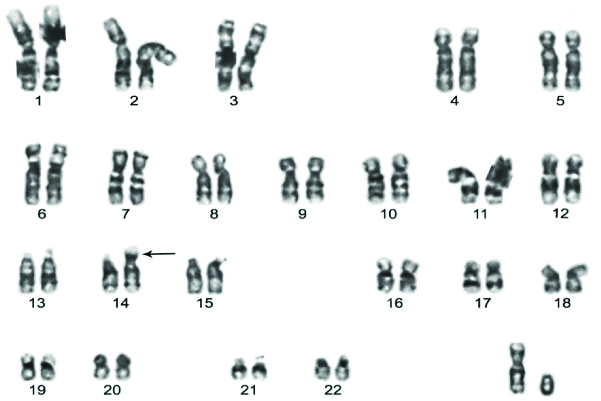 The Karyotype Showing Typical Robertsonian Translocation T1421 In Down Syndrome Case 2064