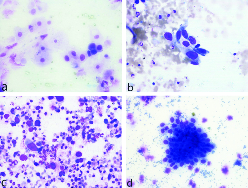 Transitional Cell Carcinoma Cytology