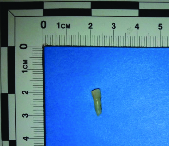 Tooth positioned such that the long axis of the tooth is perpendicular ...