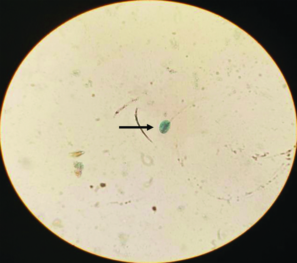 Frequency Of Giardiasis By Gender 4541