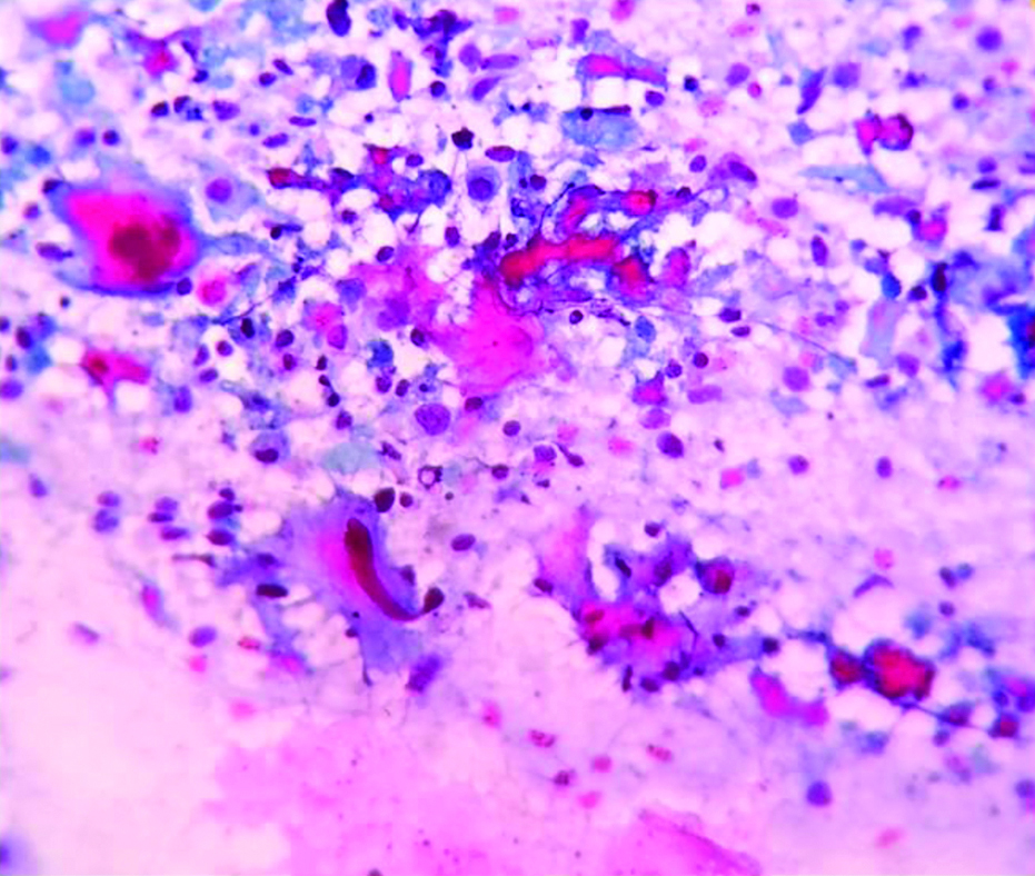 Microphotograph of cytology smear of metastatic squamous cell carcinoma ...
