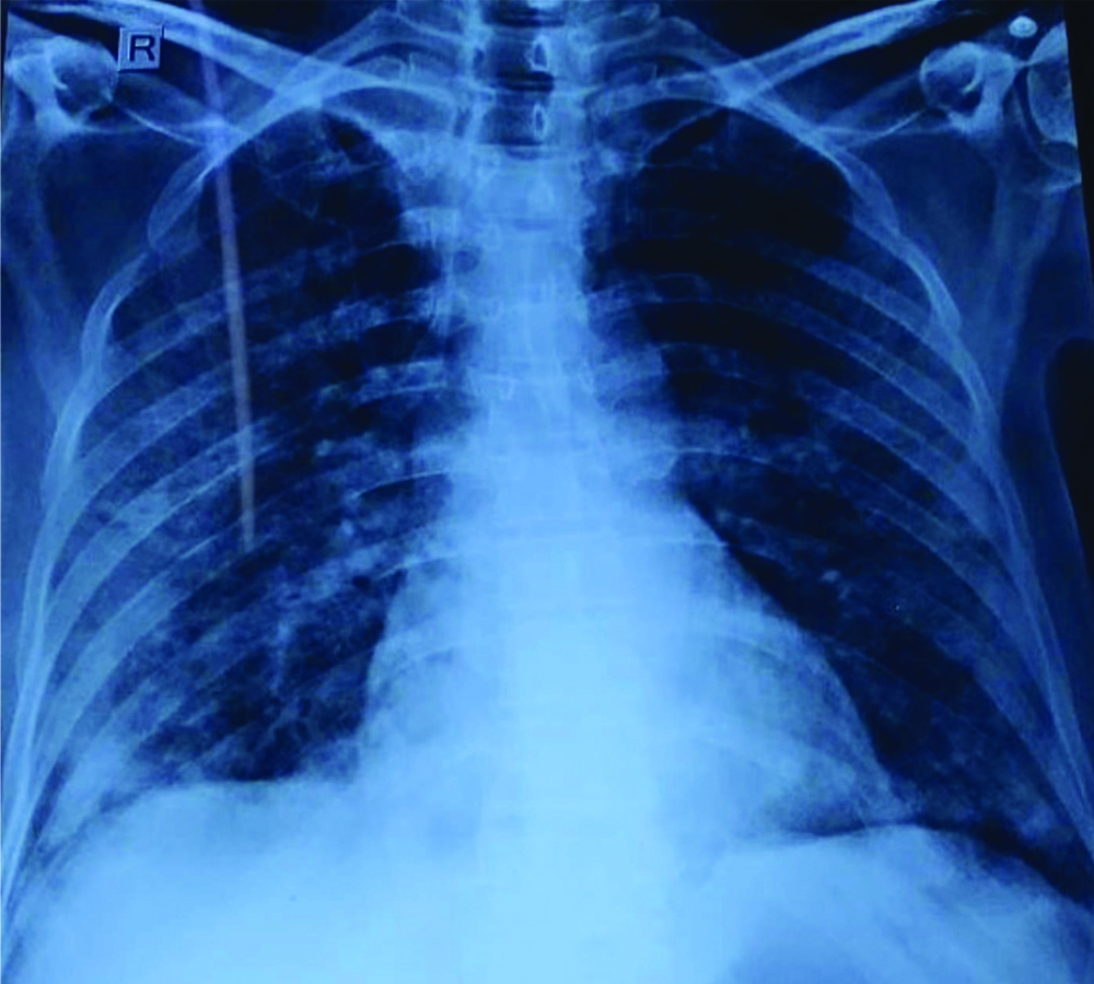 CT scan showed consolidatory patches with adjacent ground glass patches ...