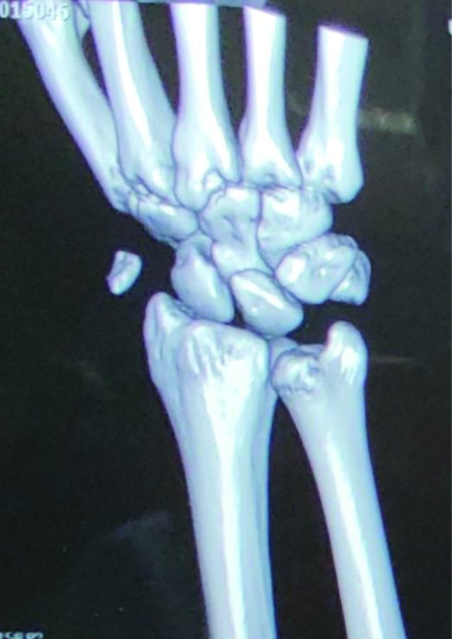 Avulsion Fracture Hand