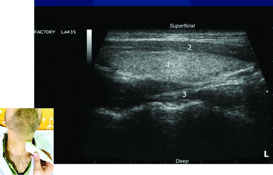 [1-right lobe, 2-strap muscles, 3-longus colli muscle]