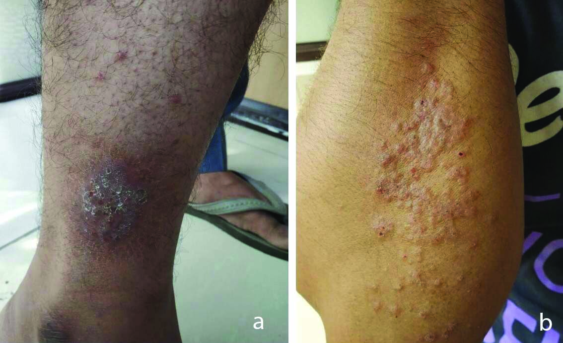 Primary Cutaneous Cryptococcosis Lesions: A) Ulcerative Lesion On ...