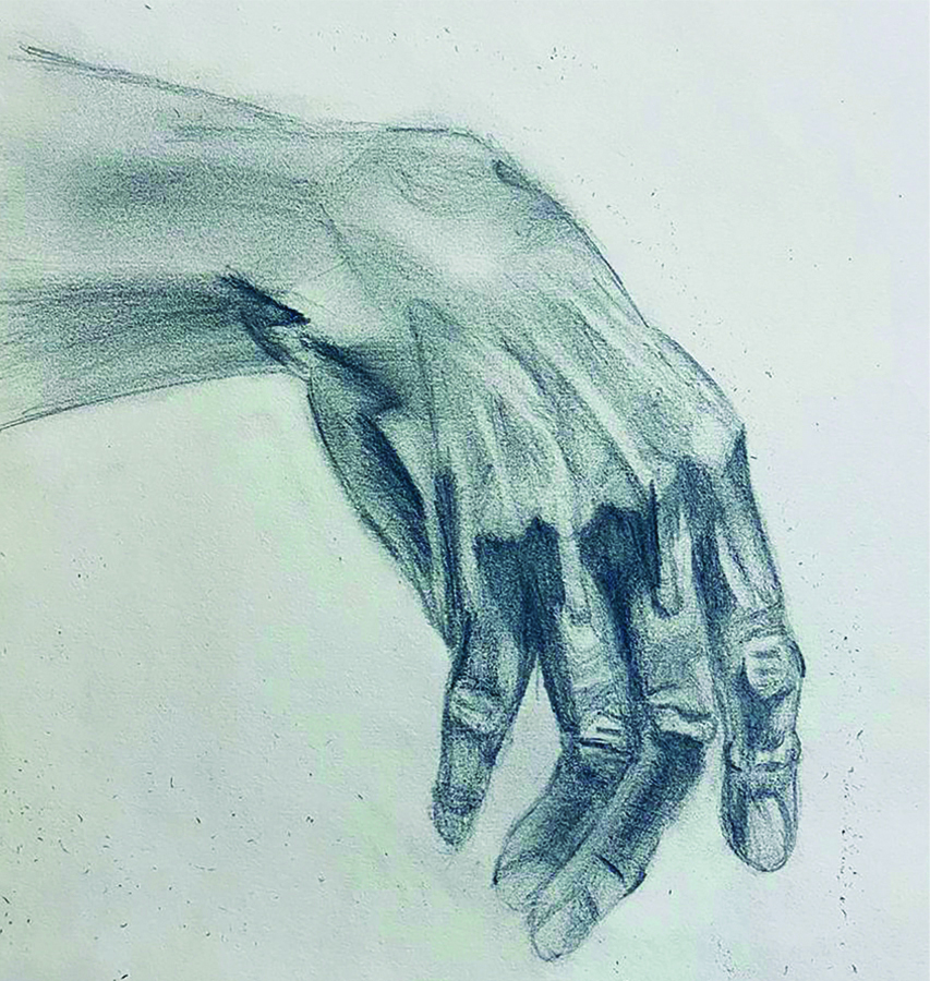 Supple wrist and finger joints without contractures.