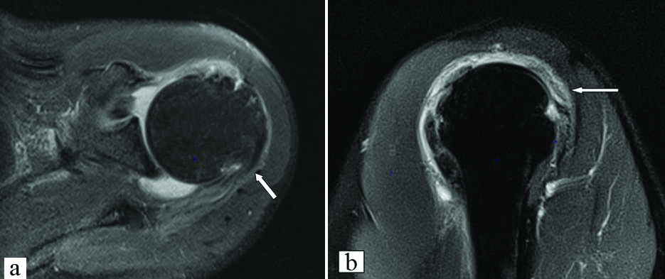 Grading of the tendinosis.