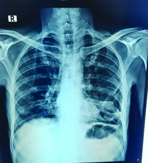 Post Intercostal Drainage Tube (ICD) removal, chest radiograph on day ...
