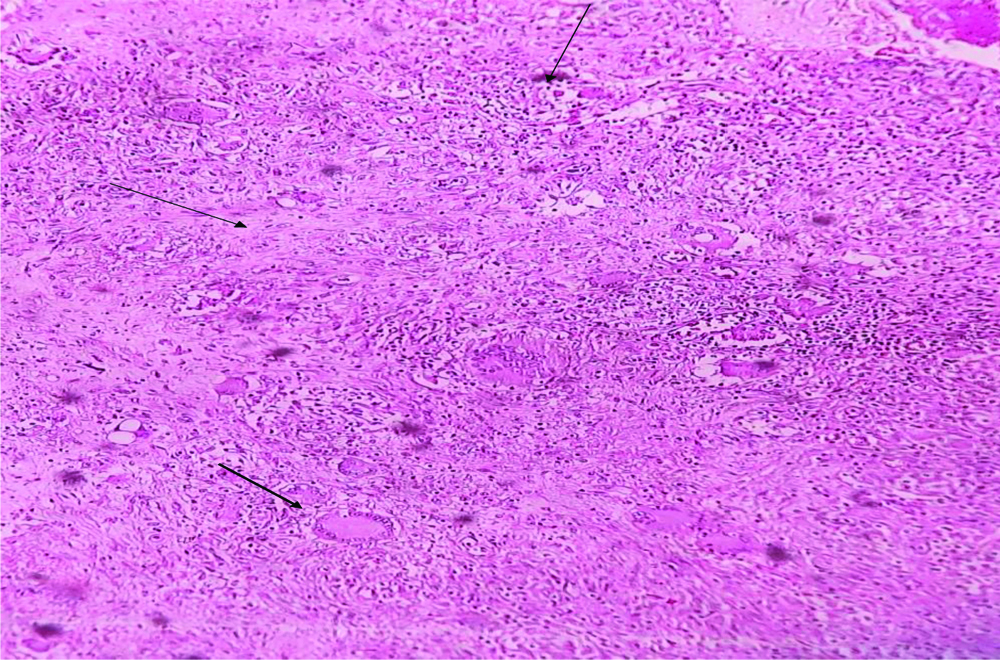 Caseation Hitopath ATT: Anti TB Treatment