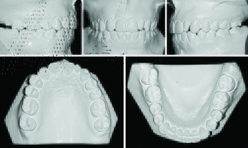 Post-treatment dental casts.
