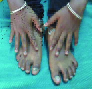 Twenty Nail Dystrophy; a case report from Disharc, Nepal - JDDonline -  Journal of Drugs in Dermatology