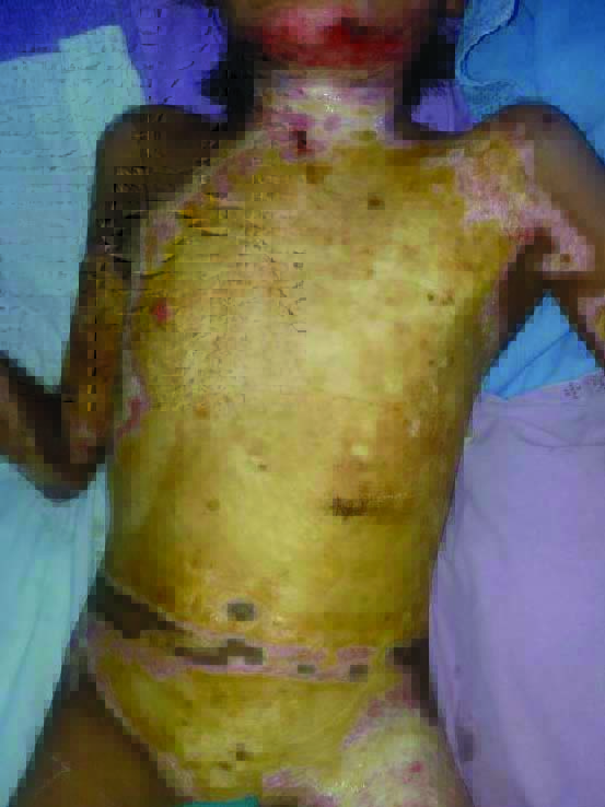 At five weeks post burns showing debridement in OT of loose eschar on ...
