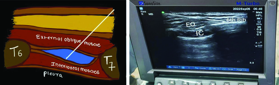 Group T: A total of 50 patients received a bilateral TAP block with 0. ...