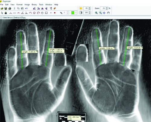 The following measurements were taken on both the right and left hands ...