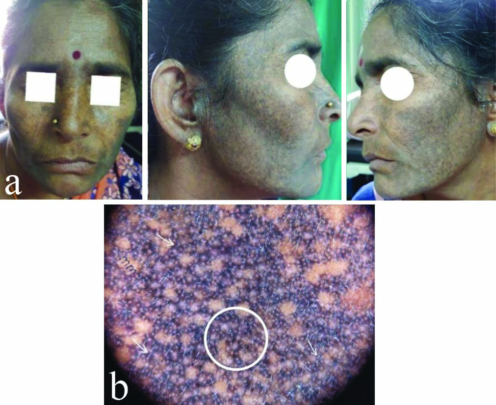 a) Clinical picture showing periorbital melanosis; b) Dermoscopic image ...