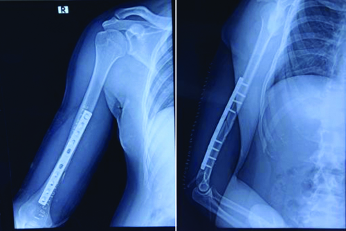 During his 6-month follow-up, the fracture was observed to have united ...